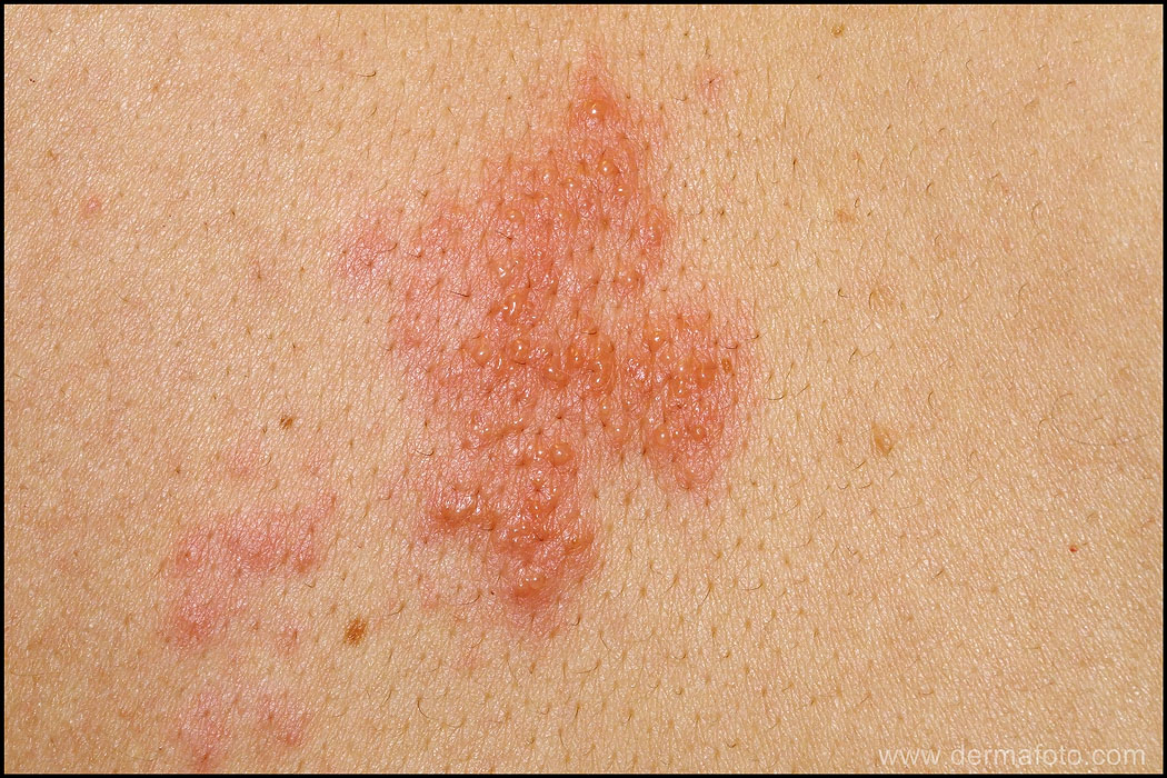 How Long Are Herpes Blisters Painful